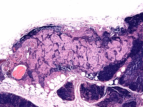 Case #13, Fig. 1