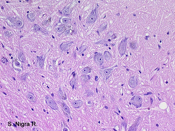 Case # 13, Fig. 2